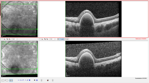 Massive subretinal hemorrhage right eye - polypoidal choroidal vasculopathy
Patient had sudden vision loss right eye.  Had vitrectomy.  The left eye had IPCV not responsive to avastin but he did respond to PDT.  See album notes for more detail.
