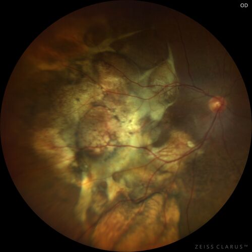 Massive subretinal hemorrhage right eye - polypoidal choroidal vasculopathy
Patient had sudden vision loss right eye.  Had vitrectomy.  The left eye had IPCV not responsive to avastin but he did respond to PDT.  See album notes for more detail.
