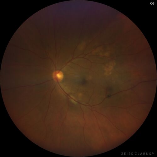 Massive subretinal hemorrhage right eye - polypoidal choroidal vasculopathy
Patient had sudden vision loss right eye.  Had vitrectomy.  The left eye had IPCV not responsive to avastin but he did respond to PDT.  See album notes for more detail.
