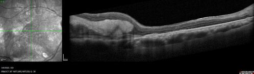 Massive subretinal hemorrhage right eye - polypoidal choroidal vasculopathy
Patient had sudden vision loss right eye.  Had vitrectomy.  The left eye had IPCV not responsive to avastin but he did respond to PDT.  See album notes for more detail.
