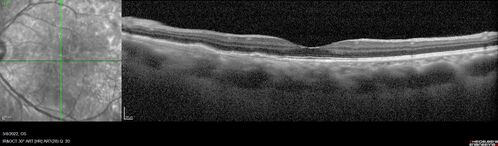 Massive subretinal hemorrhage right eye - polypoidal choroidal vasculopathy
Patient had sudden vision loss right eye.  Had vitrectomy.  The left eye had IPCV not responsive to avastin but he did respond to PDT.  See album notes for more detail.
