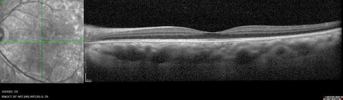Massive subretinal hemorrhage right eye - polypoidal choroidal vasculopathy
Patient had sudden vision loss right eye.  Had vitrectomy.  The left eye had IPCV not responsive to avastin but he did respond to PDT.  See album notes for more detail.
