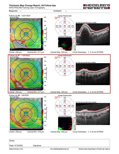 Massive subretinal hemorrhage right eye - polypoidal choroidal vasculopathy
Patient had sudden vision loss right eye.  Had vitrectomy.  The left eye had IPCV not responsive to avastin but he did respond to PDT.  See album notes for more detail.
