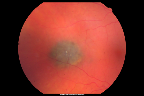 IPCV - idiopathic polypoidal choroidal vasculopathy - juxtapapillary CNVM with hemorrhage both eyes (also choroidal nevus right eye) - Subretinal hemorrhage both eyes
86 year old woman with shadow in vision OD and new hemmorhage OU.  Choroidal nevus
