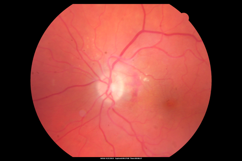 IPCV - idiopathic polypoidal choroidal vasculopathy - juxtapapillary CNVM with hemorrhage both eyes (also choroidal nevus right eye) - Subretinal hemorrhage both eyes
86 year old woman with shadow in vision OD and new hemmorhage OU.

