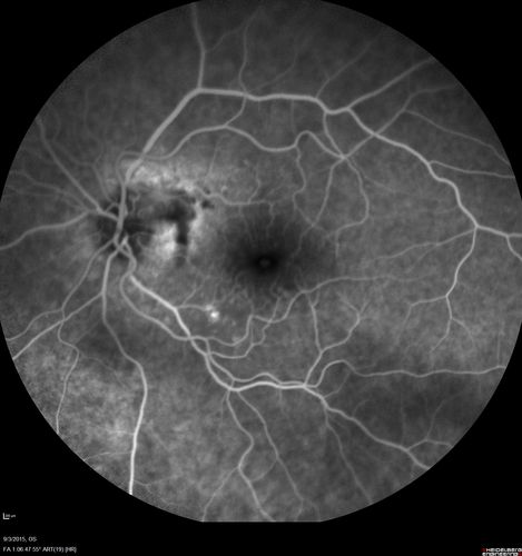 IPCV - idiopathic polypoidal choroidal vasculopathy - juxtapapillary CNVM with hemorrhage both eyes (also choroidal nevus right eye) - Subretinal hemorrhage both eyes
86 year old woman with shadow in vision OD and new hemmorhage OU.FA shows juxtapapillary CNVM
