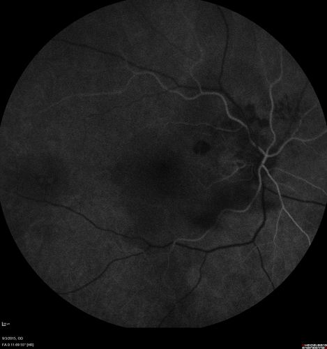 IPCV - idiopathic polypoidal choroidal vasculopathy - juxtapapillary CNVM with hemorrhage both eyes (also choroidal nevus right eye) - Subretinal hemorrhage both eyes
86 year old woman with shadow in vision OD and new hemmorhage OU.FA shows juxtapapillary CNVM
