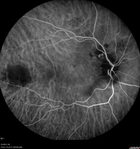 IPCV - idiopathic polypoidal choroidal vasculopathy - juxtapapillary CNVM with hemorrhage both eyes (also choroidal nevus right eye) - Subretinal hemorrhage both eyes
86 year old woman with shadow in vision OD and new hemmorhage OU. ICG angiogram
