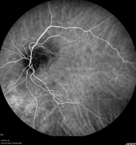 IPCV - idiopathic polypoidal choroidal vasculopathy - juxtapapillary CNVM with hemorrhage both eyes (also choroidal nevus right eye) - Subretinal hemorrhage both eyes
86 year old woman with shadow in vision OD and new hemmorhage OU. ICG angiogram
