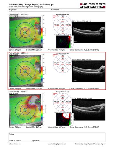 IPCV - idiopathic polypoidal choroidal vasculopathy - juxtapapillary CNVM with hemorrhage both eyes (also choroidal nevus right eye) - Subretinal hemorrhage both eyes
86 year old woman with shadow in vision OD and new hemmorhage OU.  OCT map shows progression of jpcnvm
