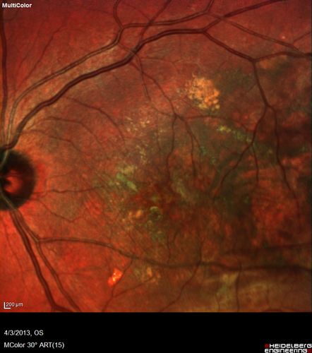 Idiopathic Polypoidal Choroidal Vasculopathy - False Color
