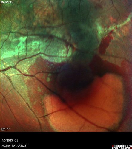 Idiopathic Polypoidal Choroidal Vasculopathy - False Color
