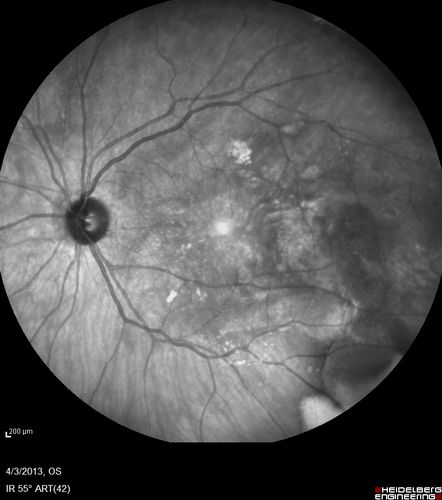Idiopathic Polypoidal Choroidal Vasculopathy - IR
