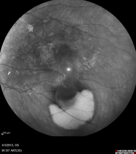 Idiopathic Polypoidal Choroidal Vasculopathy - FAF
