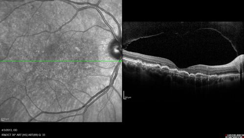 Idiopathic Polypoidal Choroidal Vasculopathy - SD-OCT
