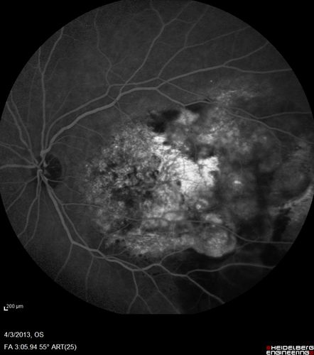 Idiopathic Polypoidal Choroidal Vasculopathy - Fluorescein Angiogram
