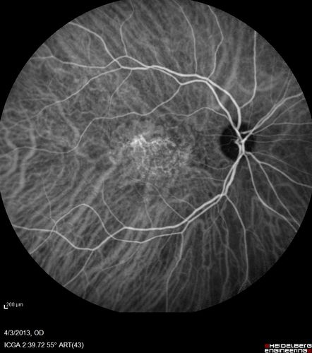 Asymptomatic Occult Subfoveal CNVM in Good Eye Visible on ICG

