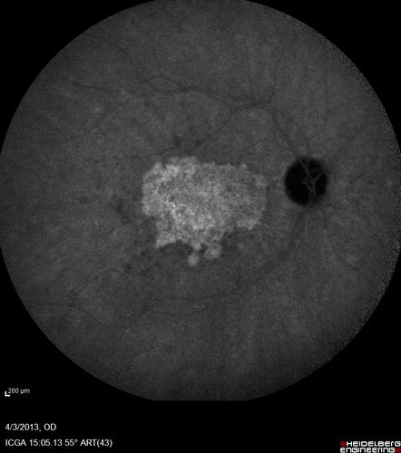 Asymptomatic Occult Subfoveal CNVM in Good Eye Visible on ICG
