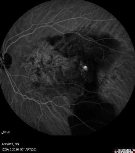 Idiopathic Polypoidal Choroidal Vasculopathy - Indocyanine Green Angiogram - Polyp Visible Left Eye.  Branching Network Both Eye
