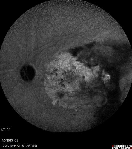Idiopathic Polypoidal Choroidal Vasculopathy - Indocyanine Green Angiogram - Polyp Visible Left Eye.  Branching Network Both Eye
