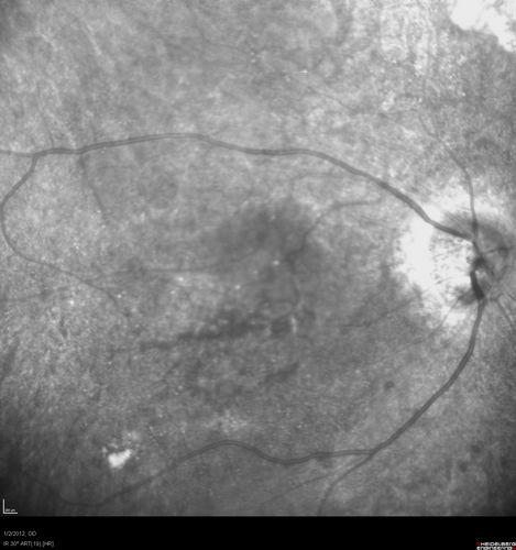 Post-Retinal Detachment Repair Occult Subfoveal CNVM
This pleasant 56-year-old man has had a complex retinal detachment repair in the right eye.  I most recently removed his silicone oil 3 months ago.  His vision now is the best it has ever been. 
VISUAL ACUITY:  OD 4/200

