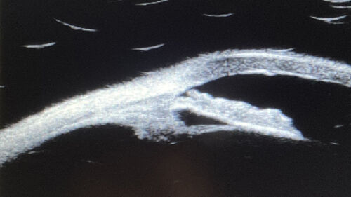 Iris Arteriovenous Malformation
