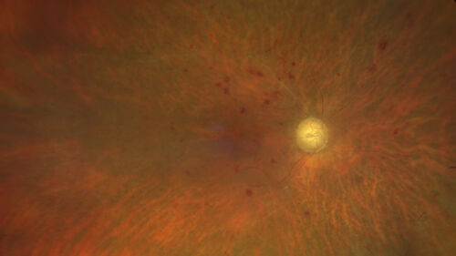 Ocular Ischemia from 100 percent right carotid occlusion
77 year old female the vision in the right eye got much worse.  She has recently been getting more severe headaches.  Her vision is now blank.  She went to her old GP in Wisconsin who said it might be sinus pressure.  Her chiropractor did an adjustment and the chiropractor checked the patient eyes and told her to go to the eye doctor.  She has been feeling pressure around her eye since the air flight.  
Specialty Meds (Initial): systane prn OU. Plavix, Combivent, ASA 325, Vitamin E, Zinc.
PSH â€“ Carotid surgery in 2000 (20 years ago), Stent 11/2022, Mastectomy 2000.
VA OD: DccCF 3ft (eccentric) NccUnable
VA OS: Dcc20/25 NccJ1
IOP: TP: OD:18 OS:16
Psuedophakic OU
Right eye had rubeosis on the pupil margin and not in the angle
Further testing showed 100 percent occlusion of the right carotid artery.  The left carotid artery was stented.

