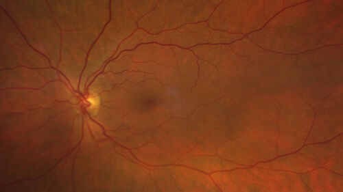 Ocular Ischemia from 100 percent right carotid occlusion
77 year old female the vision in the right eye got much worse.  She has recently been getting more severe headaches.  Her vision is now blank.  She went to her old GP in Wisconsin who said it might be sinus pressure.  Her chiropractor did an adjustment and the chiropractor checked the patient eyes and told her to go to the eye doctor.  She has been feeling pressure around her eye since the air flight.  
Specialty Meds (Initial): systane prn OU. Plavix, Combivent, ASA 325, Vitamin E, Zinc.
PSH â€“ Carotid surgery in 2000 (20 years ago), Stent 11/2022, Mastectomy 2000.
VA OD: DccCF 3ft (eccentric) NccUnable
VA OS: Dcc20/25 NccJ1
IOP: TP: OD:18 OS:16
Psuedophakic OU
Right eye had rubeosis on the pupil margin and not in the angle
Further testing showed 100 percent occlusion of the right carotid artery.  The left carotid artery was stented.
