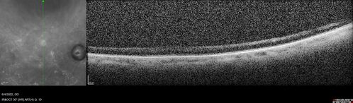 Ocular Ischemia from 100 percent right carotid occlusion
77 year old female the vision in the right eye got much worse.  She has recently been getting more severe headaches.  Her vision is now blank.  She went to her old GP in Wisconsin who said it might be sinus pressure.  Her chiropractor did an adjustment and the chiropractor checked the patient eyes and told her to go to the eye doctor.  She has been feeling pressure around her eye since the air flight.  
Specialty Meds (Initial): systane prn OU. Plavix, Combivent, ASA 325, Vitamin E, Zinc.
PSH â€“ Carotid surgery in 2000 (20 years ago), Stent 11/2022, Mastectomy 2000.
VA OD: DccCF 3ft (eccentric) NccUnable
VA OS: Dcc20/25 NccJ1
IOP: TP: OD:18 OS:16
Psuedophakic OU
Right eye had rubeosis on the pupil margin and not in the angle
Further testing showed 100 percent occlusion of the right carotid artery.  The left carotid artery was stented.
