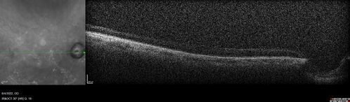 Ocular Ischemia from 100 percent right carotid occlusion
77 year old female the vision in the right eye got much worse.  She has recently been getting more severe headaches.  Her vision is now blank.  She went to her old GP in Wisconsin who said it might be sinus pressure.  Her chiropractor did an adjustment and the chiropractor checked the patient eyes and told her to go to the eye doctor.  She has been feeling pressure around her eye since the air flight.  
Specialty Meds (Initial): systane prn OU. Plavix, Combivent, ASA 325, Vitamin E, Zinc.
PSH â€“ Carotid surgery in 2000 (20 years ago), Stent 11/2022, Mastectomy 2000.
VA OD: DccCF 3ft (eccentric) NccUnable
VA OS: Dcc20/25 NccJ1
IOP: TP: OD:18 OS:16
Psuedophakic OU
Right eye had rubeosis on the pupil margin and not in the angle
Further testing showed 100 percent occlusion of the right carotid artery.  The left carotid artery was stented.
