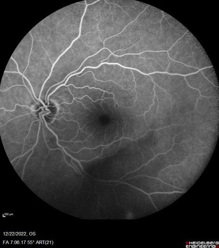 Ocular Ischemia from 100 percent right carotid occlusion
77 year old female the vision in the right eye got much worse.  She has recently been getting more severe headaches.  Her vision is now blank.  She went to her old GP in Wisconsin who said it might be sinus pressure.  Her chiropractor did an adjustment and the chiropractor checked the patient eyes and told her to go to the eye doctor.  She has been feeling pressure around her eye since the air flight.  
Specialty Meds (Initial): systane prn OU. Plavix, Combivent, ASA 325, Vitamin E, Zinc.
PSH â€“ Carotid surgery in 2000 (20 years ago), Stent 11/2022, Mastectomy 2000.
VA OD: DccCF 3ft (eccentric) NccUnable
VA OS: Dcc20/25 NccJ1
IOP: TP: OD:18 OS:16
Psuedophakic OU
Right eye had rubeosis on the pupil margin and not in the angle
Further testing showed 100 percent occlusion of the right carotid artery.  The left carotid artery was stented.

