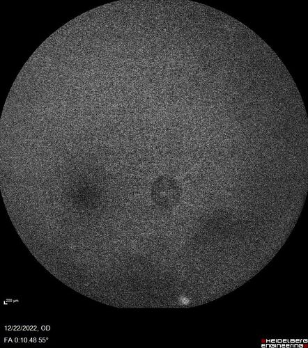 Ocular Ischemia from 100 percent right carotid occlusion
77 year old female the vision in the right eye got much worse.  She has recently been getting more severe headaches.  Her vision is now blank.  She went to her old GP in Wisconsin who said it might be sinus pressure.  Her chiropractor did an adjustment and the chiropractor checked the patient eyes and told her to go to the eye doctor.  She has been feeling pressure around her eye since the air flight.  
Specialty Meds (Initial): systane prn OU. Plavix, Combivent, ASA 325, Vitamin E, Zinc.
PSH â€“ Carotid surgery in 2000 (20 years ago), Stent 11/2022, Mastectomy 2000.
VA OD: DccCF 3ft (eccentric) NccUnable
VA OS: Dcc20/25 NccJ1
IOP: TP: OD:18 OS:16
Psuedophakic OU
Right eye had rubeosis on the pupil margin and not in the angle
Further testing showed 100 percent occlusion of the right carotid artery.  The left carotid artery was stented.
