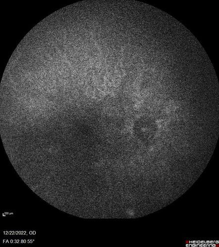 Ocular Ischemia from 100 percent right carotid occlusion
77 year old female the vision in the right eye got much worse.  She has recently been getting more severe headaches.  Her vision is now blank.  She went to her old GP in Wisconsin who said it might be sinus pressure.  Her chiropractor did an adjustment and the chiropractor checked the patient eyes and told her to go to the eye doctor.  She has been feeling pressure around her eye since the air flight.  
Specialty Meds (Initial): systane prn OU. Plavix, Combivent, ASA 325, Vitamin E, Zinc.
PSH â€“ Carotid surgery in 2000 (20 years ago), Stent 11/2022, Mastectomy 2000.
VA OD: DccCF 3ft (eccentric) NccUnable
VA OS: Dcc20/25 NccJ1
IOP: TP: OD:18 OS:16
Psuedophakic OU
Right eye had rubeosis on the pupil margin and not in the angle
Further testing showed 100 percent occlusion of the right carotid artery.  The left carotid artery was stented.
