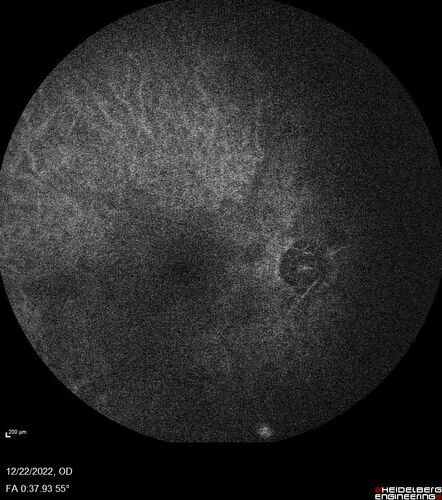 Ocular Ischemia from 100 percent right carotid occlusion
77 year old female the vision in the right eye got much worse.  She has recently been getting more severe headaches.  Her vision is now blank.  She went to her old GP in Wisconsin who said it might be sinus pressure.  Her chiropractor did an adjustment and the chiropractor checked the patient eyes and told her to go to the eye doctor.  She has been feeling pressure around her eye since the air flight.  
Specialty Meds (Initial): systane prn OU. Plavix, Combivent, ASA 325, Vitamin E, Zinc.
PSH â€“ Carotid surgery in 2000 (20 years ago), Stent 11/2022, Mastectomy 2000.
VA OD: DccCF 3ft (eccentric) NccUnable
VA OS: Dcc20/25 NccJ1
IOP: TP: OD:18 OS:16
Psuedophakic OU
Right eye had rubeosis on the pupil margin and not in the angle
Further testing showed 100 percent occlusion of the right carotid artery.  The left carotid artery was stented.

