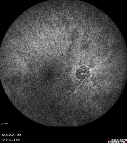 Ocular Ischemia from 100 percent right carotid occlusion
77 year old female the vision in the right eye got much worse.  She has recently been getting more severe headaches.  Her vision is now blank.  She went to her old GP in Wisconsin who said it might be sinus pressure.  Her chiropractor did an adjustment and the chiropractor checked the patient eyes and told her to go to the eye doctor.  She has been feeling pressure around her eye since the air flight.  
Specialty Meds (Initial): systane prn OU. Plavix, Combivent, ASA 325, Vitamin E, Zinc.
PSH â€“ Carotid surgery in 2000 (20 years ago), Stent 11/2022, Mastectomy 2000.
VA OD: DccCF 3ft (eccentric) NccUnable
VA OS: Dcc20/25 NccJ1
IOP: TP: OD:18 OS:16
Psuedophakic OU
Right eye had rubeosis on the pupil margin and not in the angle
Further testing showed 100 percent occlusion of the right carotid artery.  The left carotid artery was stented.
