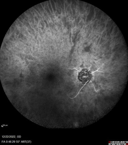 Ocular Ischemia from 100 percent right carotid occlusion
77 year old female the vision in the right eye got much worse.  She has recently been getting more severe headaches.  Her vision is now blank.  She went to her old GP in Wisconsin who said it might be sinus pressure.  Her chiropractor did an adjustment and the chiropractor checked the patient eyes and told her to go to the eye doctor.  She has been feeling pressure around her eye since the air flight.  
Specialty Meds (Initial): systane prn OU. Plavix, Combivent, ASA 325, Vitamin E, Zinc.
PSH â€“ Carotid surgery in 2000 (20 years ago), Stent 11/2022, Mastectomy 2000.
VA OD: DccCF 3ft (eccentric) NccUnable
VA OS: Dcc20/25 NccJ1
IOP: TP: OD:18 OS:16
Psuedophakic OU
Right eye had rubeosis on the pupil margin and not in the angle
Further testing showed 100 percent occlusion of the right carotid artery.  The left carotid artery was stented.
