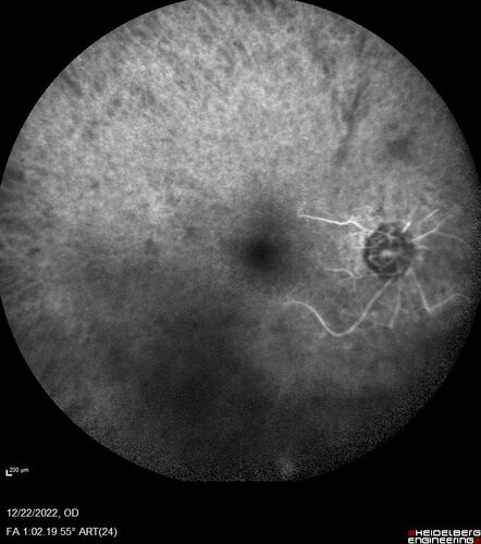 Ocular Ischemia from 100 percent right carotid occlusion
77 year old female the vision in the right eye got much worse.  She has recently been getting more severe headaches.  Her vision is now blank.  She went to her old GP in Wisconsin who said it might be sinus pressure.  Her chiropractor did an adjustment and the chiropractor checked the patient eyes and told her to go to the eye doctor.  She has been feeling pressure around her eye since the air flight.  
Specialty Meds (Initial): systane prn OU. Plavix, Combivent, ASA 325, Vitamin E, Zinc.
PSH â€“ Carotid surgery in 2000 (20 years ago), Stent 11/2022, Mastectomy 2000.
VA OD: DccCF 3ft (eccentric) NccUnable
VA OS: Dcc20/25 NccJ1
IOP: TP: OD:18 OS:16
Psuedophakic OU
Right eye had rubeosis on the pupil margin and not in the angle
Further testing showed 100 percent occlusion of the right carotid artery.  The left carotid artery was stented.
