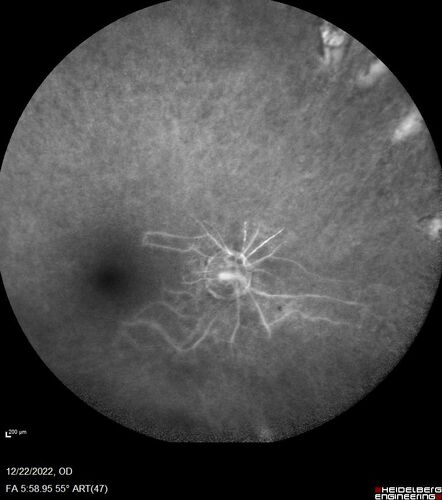 Ocular Ischemia from 100 percent right carotid occlusion
77 year old female the vision in the right eye got much worse.  She has recently been getting more severe headaches.  Her vision is now blank.  She went to her old GP in Wisconsin who said it might be sinus pressure.  Her chiropractor did an adjustment and the chiropractor checked the patient eyes and told her to go to the eye doctor.  She has been feeling pressure around her eye since the air flight.  
Specialty Meds (Initial): systane prn OU. Plavix, Combivent, ASA 325, Vitamin E, Zinc.
PSH â€“ Carotid surgery in 2000 (20 years ago), Stent 11/2022, Mastectomy 2000.
VA OD: DccCF 3ft (eccentric) NccUnable
VA OS: Dcc20/25 NccJ1
IOP: TP: OD:18 OS:16
Psuedophakic OU
Right eye had rubeosis on the pupil margin and not in the angle
Further testing showed 100 percent occlusion of the right carotid artery.  The left carotid artery was stented.
