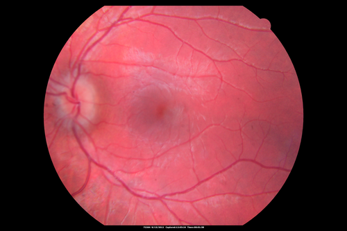 Papilledema - Spectral Domain OCT used for Diagnosis - 14 year old Child
14-year-old was with optic nerve swelling asymptomatic - picked up during routine eye exam.  OD 20/20,  OS 20/32
SD-OCT is used to differentiate optic disc edema from optic nerve head drusen (which are not yet calcified in children).
