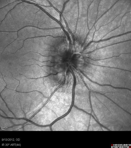 Papilledema - Spectral Domain OCT used for Diagnosis - 14 year old Child - IR Photo
14-year-old was with optic nerve swelling asymptomatic - picked up during routine eye exam.  OD 20/20,  OS 20/32
SD-OCT is used to differentiate optic disc edema from optic nerve head drusen (which are not yet calcified in children).
