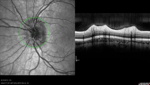 Papilledema - Spectral Domain OCT used for Diagnosis - 14 year old Child - Nerve Fiber Layer Scan shows swelling
14-year-old was with optic nerve swelling asymptomatic - picked up during routine eye exam.  OD 20/20,  OS 20/32
SD-OCT is used to differentiate optic disc edema from optic nerve head drusen (which are not yet calcified in children).
