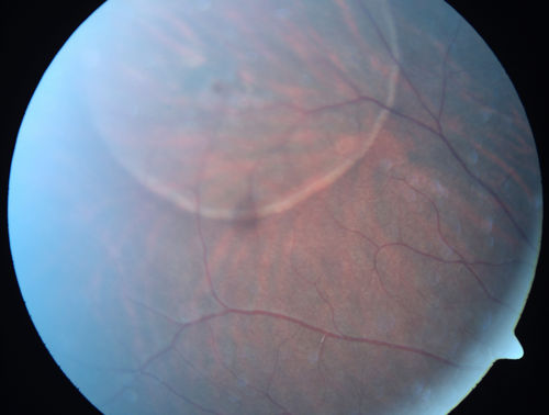 Asymptomatic Retinal Detachment Confirmed with Optical Coherence Tomography (OCT)
24-year-old 20/20 vision in each eye.  Patient referred for retinoschisis.  OCT confirmed retinal detachment.  Patient is very active and in military so the detachment was treated with laser demarcation.

