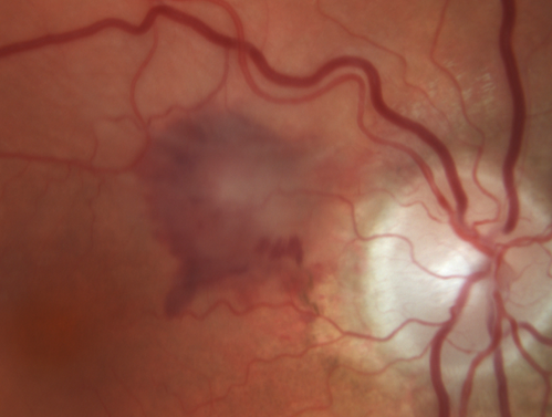 Juxtapapillary CNVM - Hemorrhage
83 year old female VA 20/200 improved to 20/32 within 2 months with Lucentis
