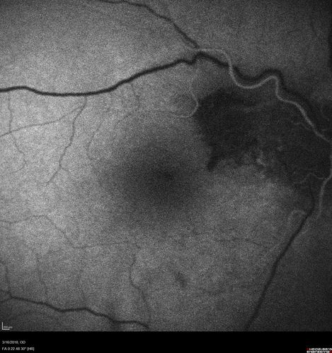 Juxtapapillary CNVM - Hemorrhage
83 year old female VA 20/200 improved to 20/32 within 2 months with Lucentis
