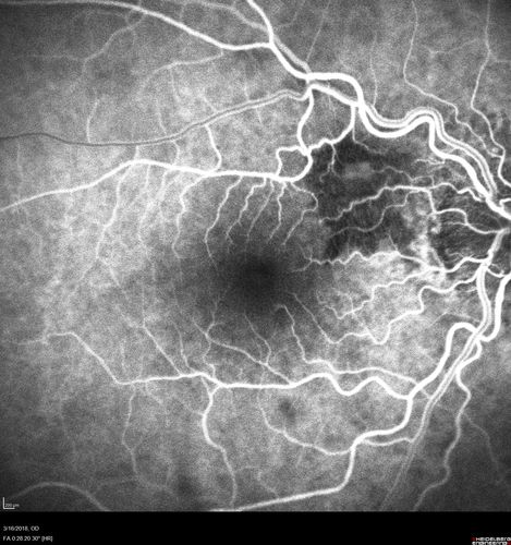 Juxtapapillary CNVM - Hemorrhage
83 year old female VA 20/200 improved to 20/32 within 2 months with Lucentis
