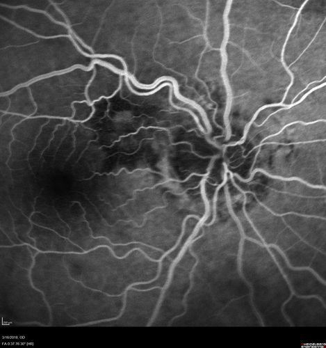 Juxtapapillary CNVM - Hemorrhage
83 year old female VA 20/200 improved to 20/32 within 2 months with Lucentis

