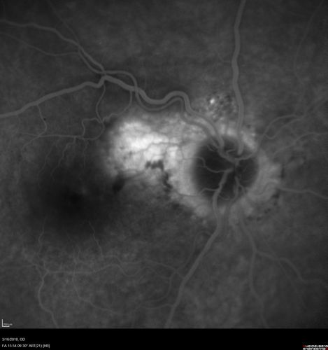 Juxtapapillary CNVM - Hemorrhage
83 year old female VA 20/200 improved to 20/32 within 2 months with Lucentis
