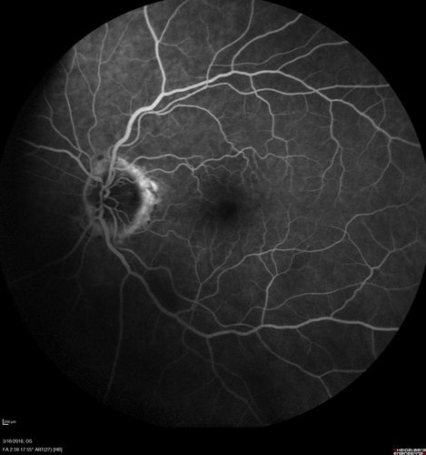 Juxtapapillary CNVM - Hemorrhage
83 year old female VA 20/200 improved to 20/32 within 2 months with Lucentis
