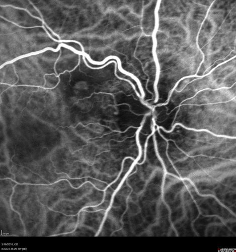 Juxtapapillary CNVM - Hemorrhage
83 year old female VA 20/200 improved to 20/32 within 2 months with Lucentis
