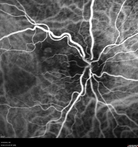 Juxtapapillary CNVM - Hemorrhage
83 year old female VA 20/200 improved to 20/32 within 2 months with Lucentis
